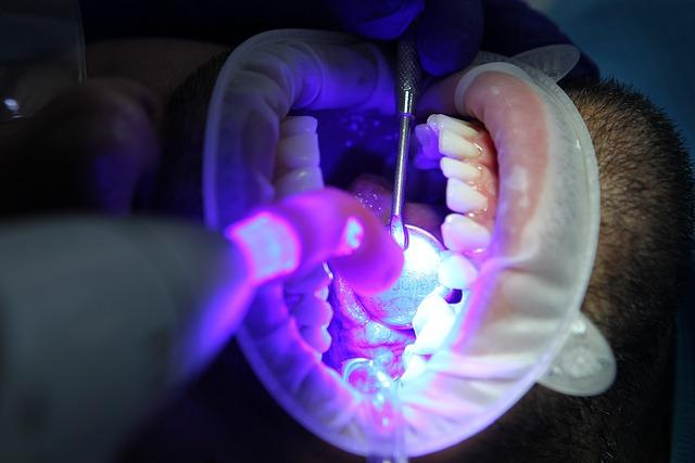Správné použití Bělení zubů 20 minute dental ‌white